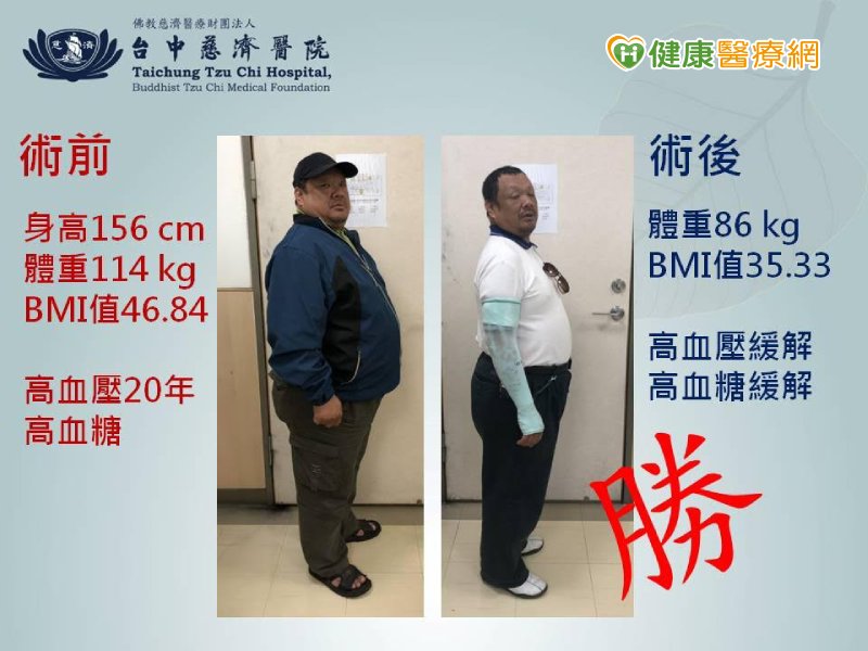 廚師減重失敗變胖大叔　縮胃手術甩24公斤肉