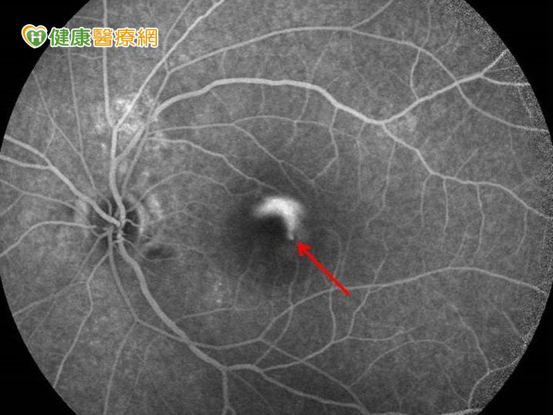 單眼視力突下降　光動力療法縮短病程